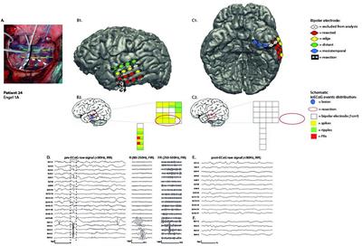 Spikes and High Frequency Oscillations in Lateral Neocortical Temporal Lobe Epilepsy: Can They Predict the Success Chance of Hippocampus-Sparing Resections?